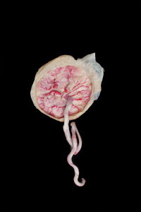 Contemporary abstract art of a plastinated placenta against black background shows the life giving and life taking qualities of this organ.